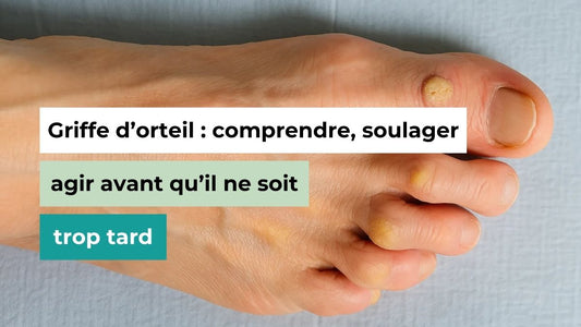 Griffe d’orteil : comprendre, soulager, agir avant qu’il ne soit trop tard - Semello.fr
