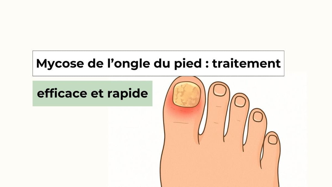 Mycose de l’ongle du pied : traitements efficaces et conseils d’experts - Semello.fr