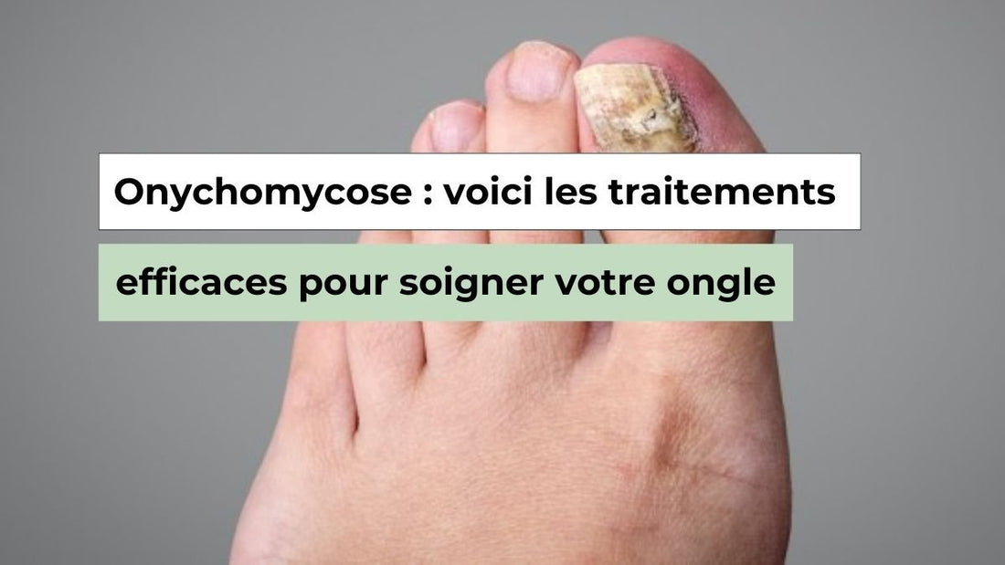 Onychomycose : les traitements vraiment efficaces pour soigner l’ongle - Semello.fr