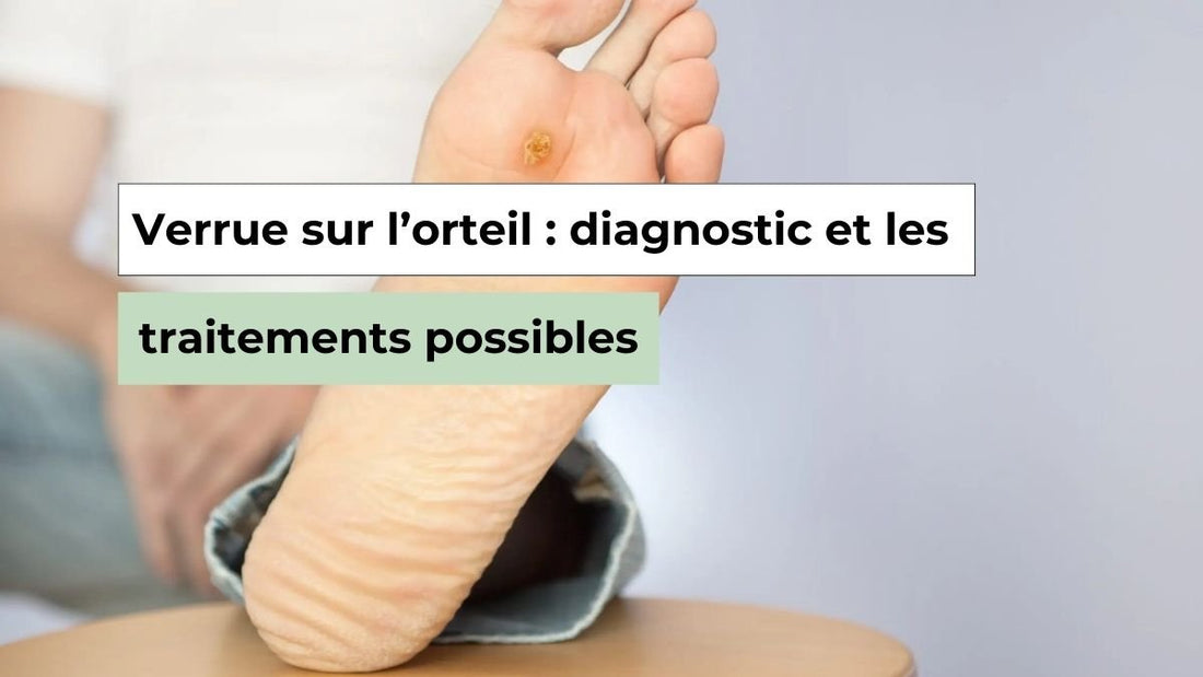 Verrue sur l’orteil : approche podologique et options de traitement - Semello.fr