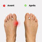 Orthèse orteil souple et discrète pour Hallux Valgus