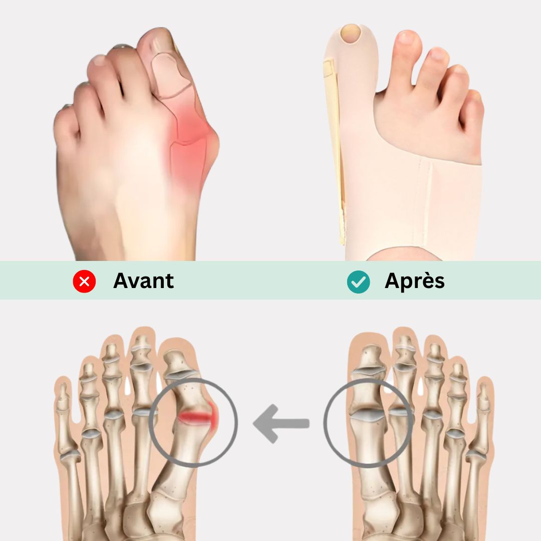 Orthèse Hallux Valgus | Discrète et Légère
