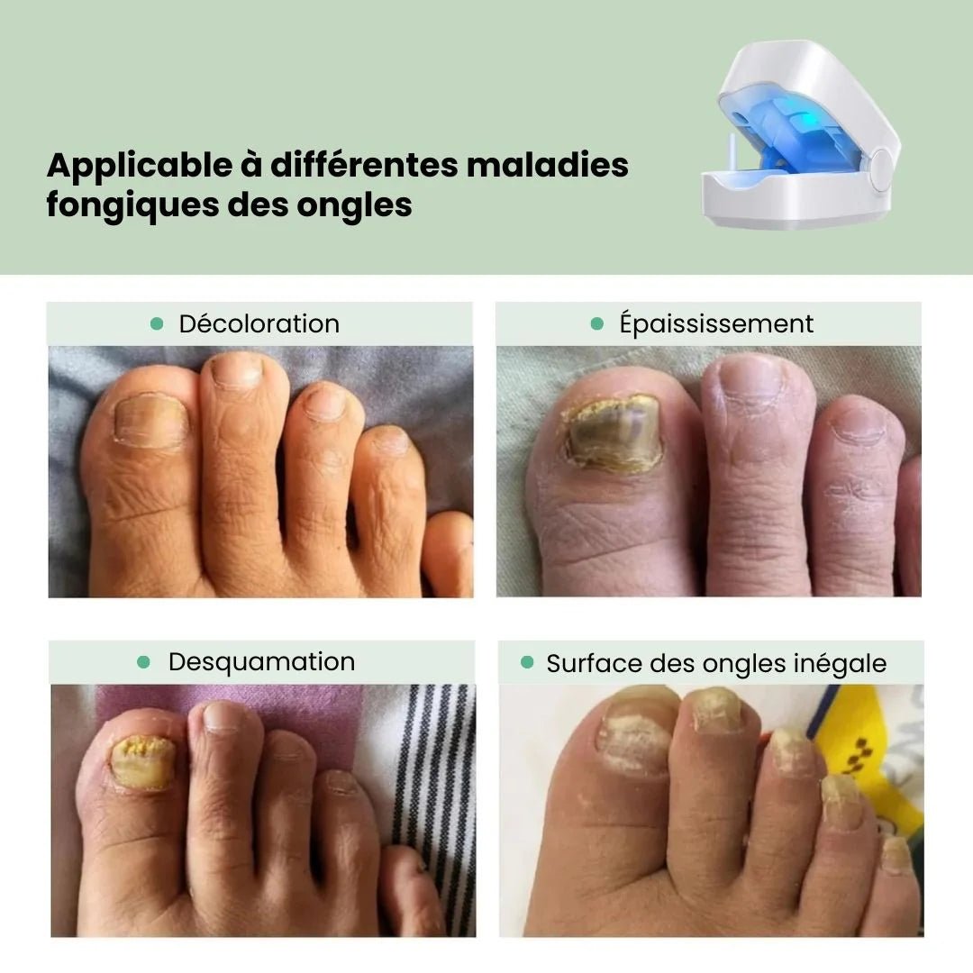 Appareil de Traitement UV des Mycoses - Semello.fr