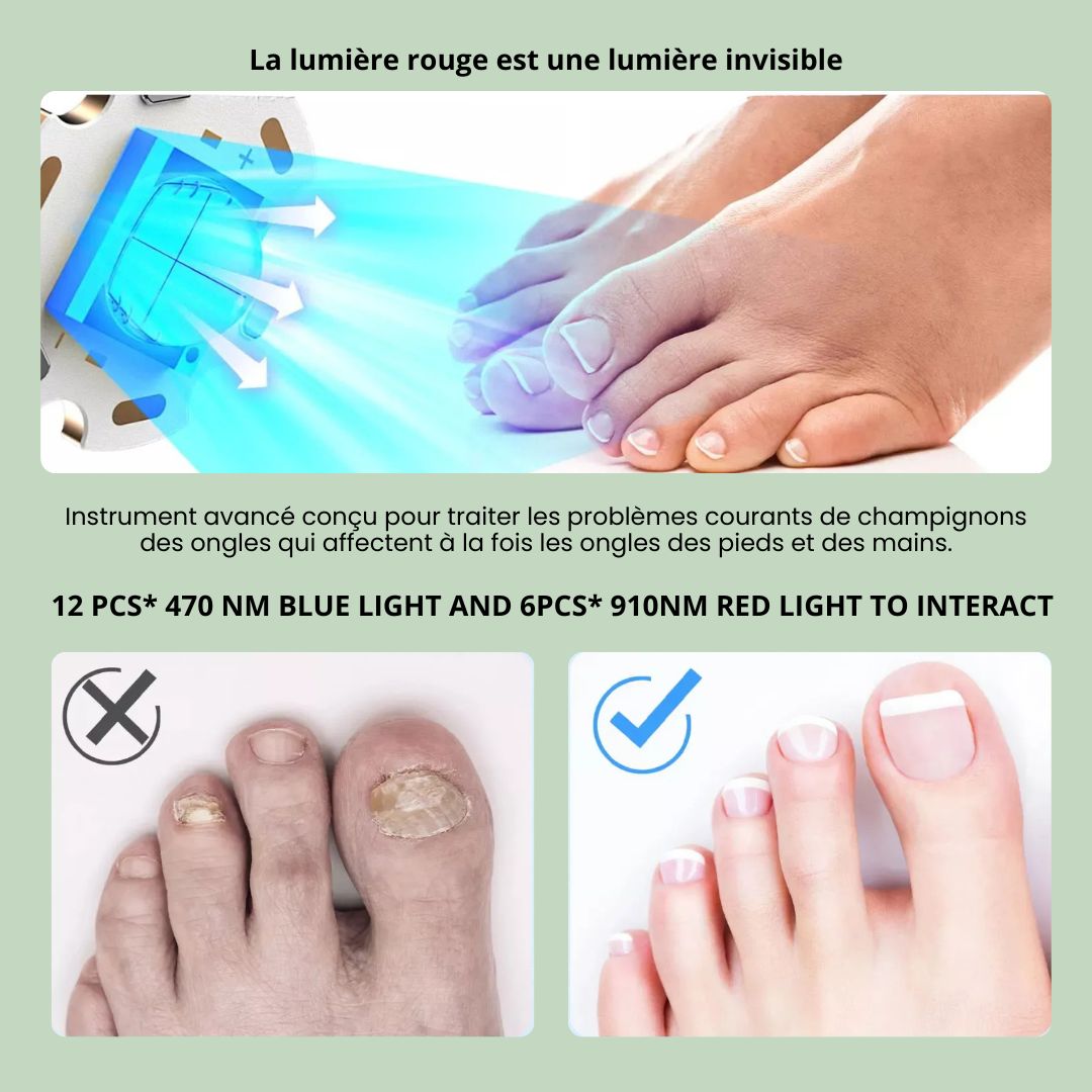 Dispositif de Traitement des Mycoses aux Ongles - Semello.fr