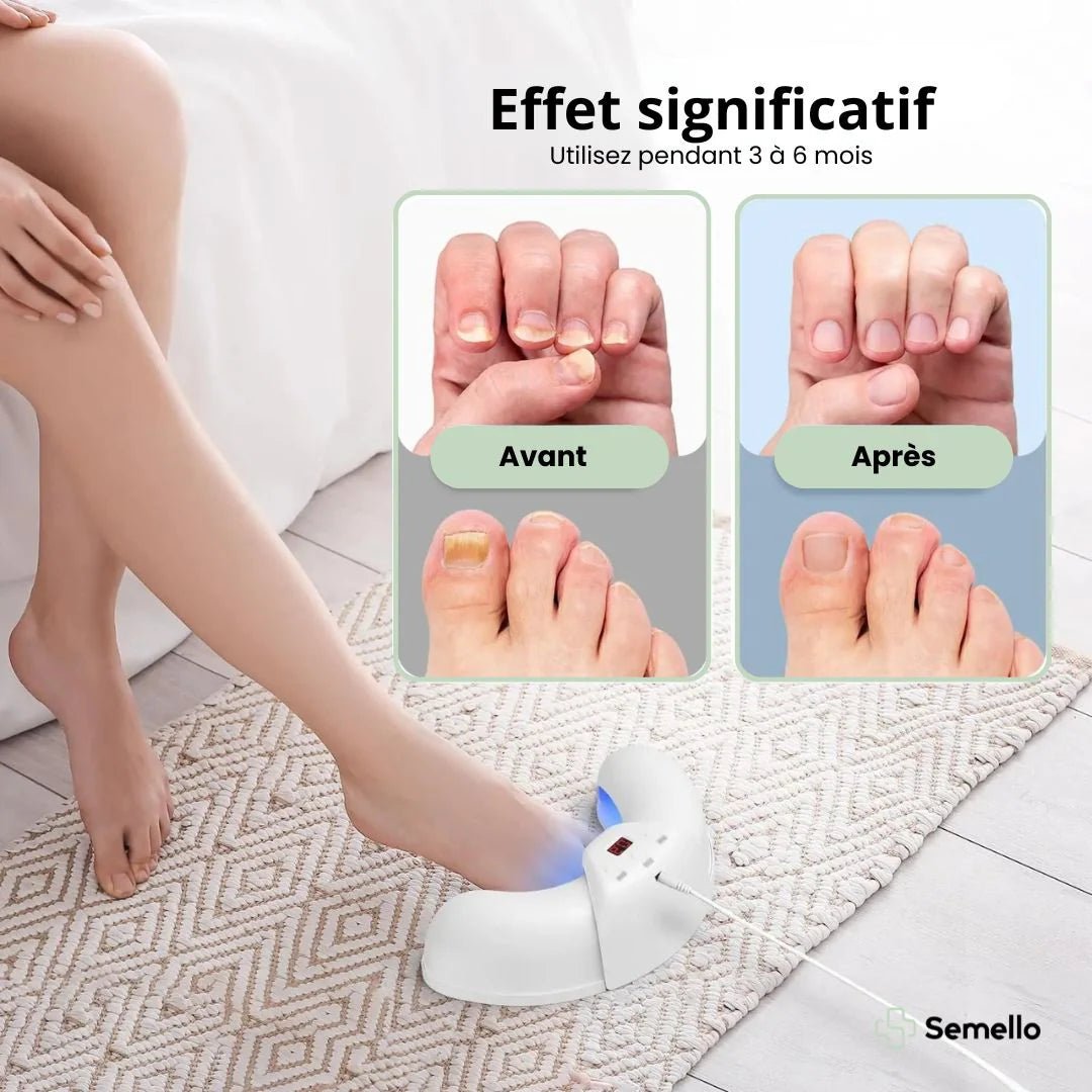 OrthoLaser® - Traitement des Mycoses aux Ongles - Semello.fr