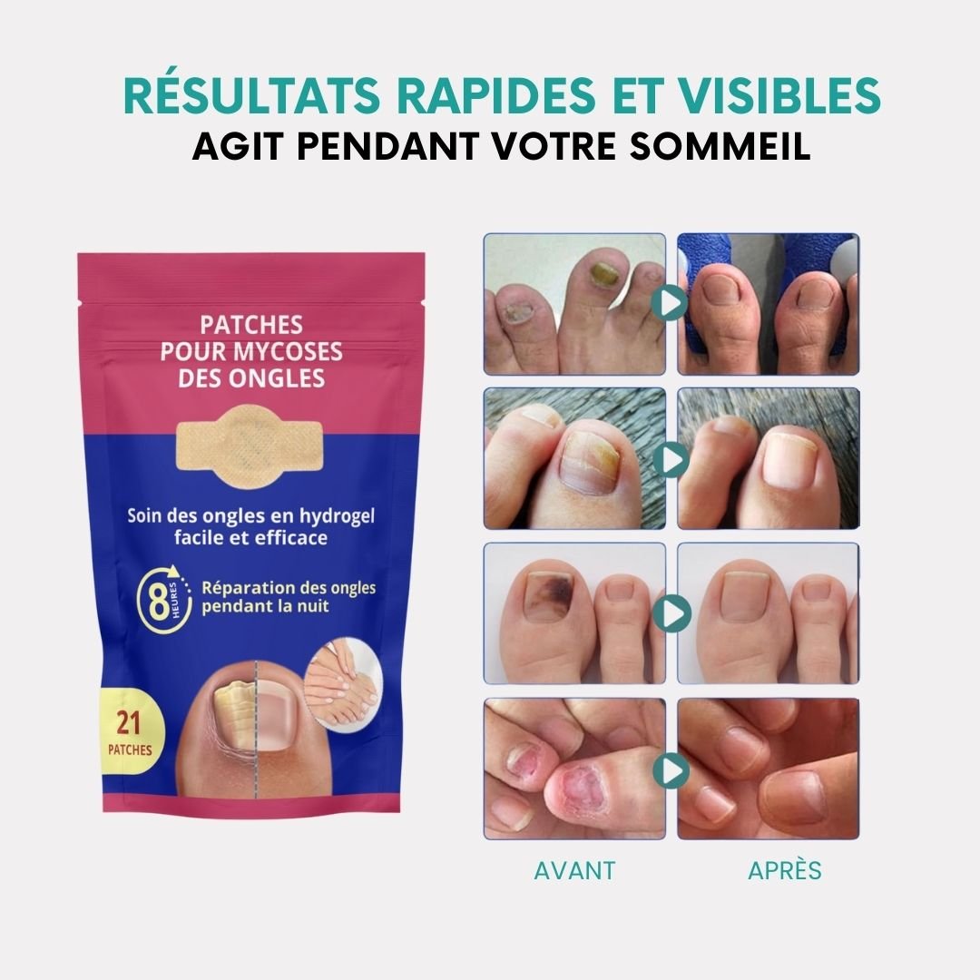 Patchs et Sérum contre les Mycoses des Ongles - Semello.fr