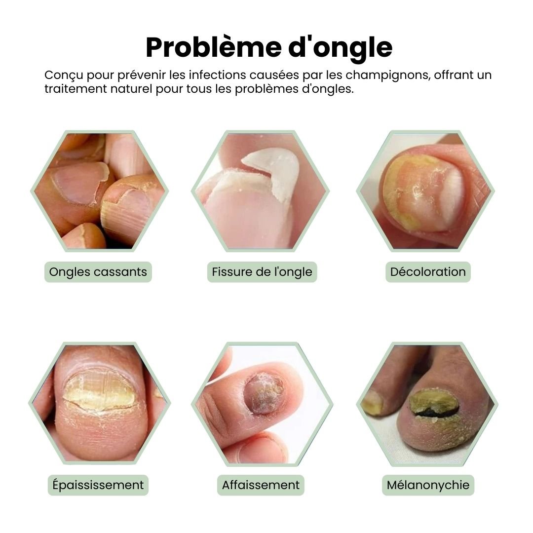 Stylo de traitement des Mycoses Lazer - Semello.fr