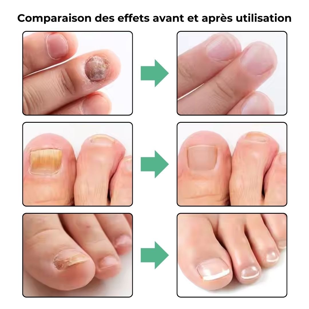 Stylo de traitement des Mycoses Lazer - Semello.fr