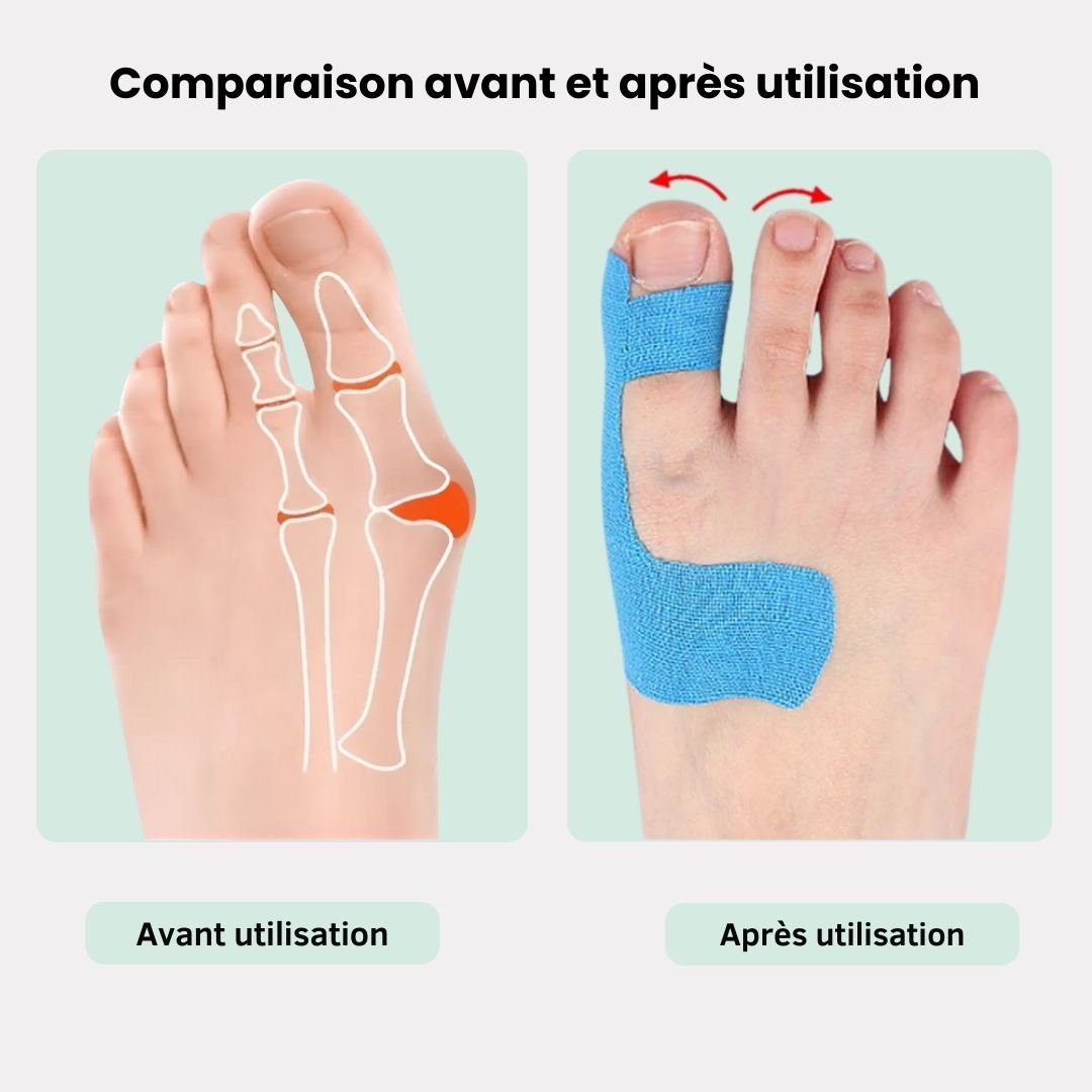 Tape pour Hallux Valgus | Soulagement & Correction - Semello.fr